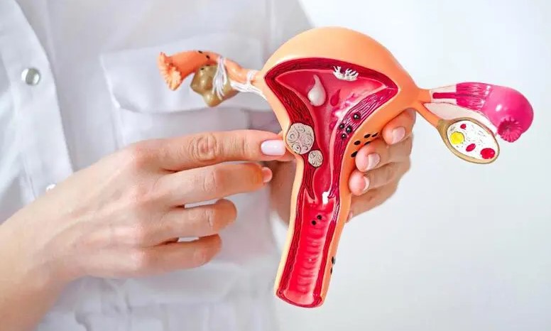 Endometriose Ttratamento - Dr Orcione Jr
