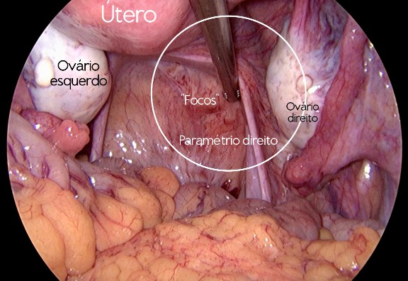 Endometriose - Síntomas